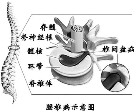腰椎病有哪些典型症状